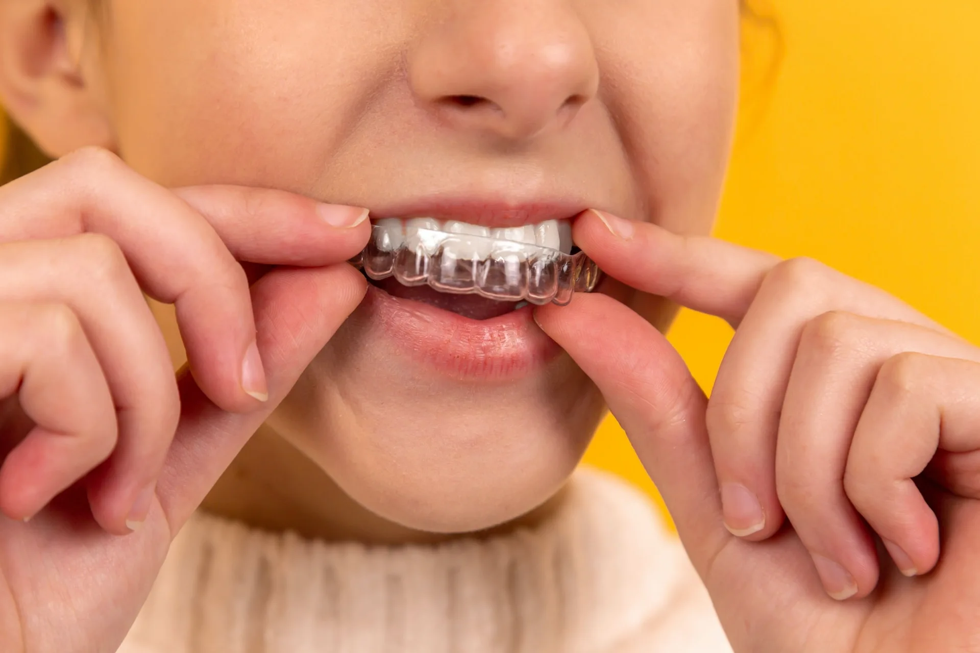 Lo que hay que saber sobre el Blanqueamiento Dental